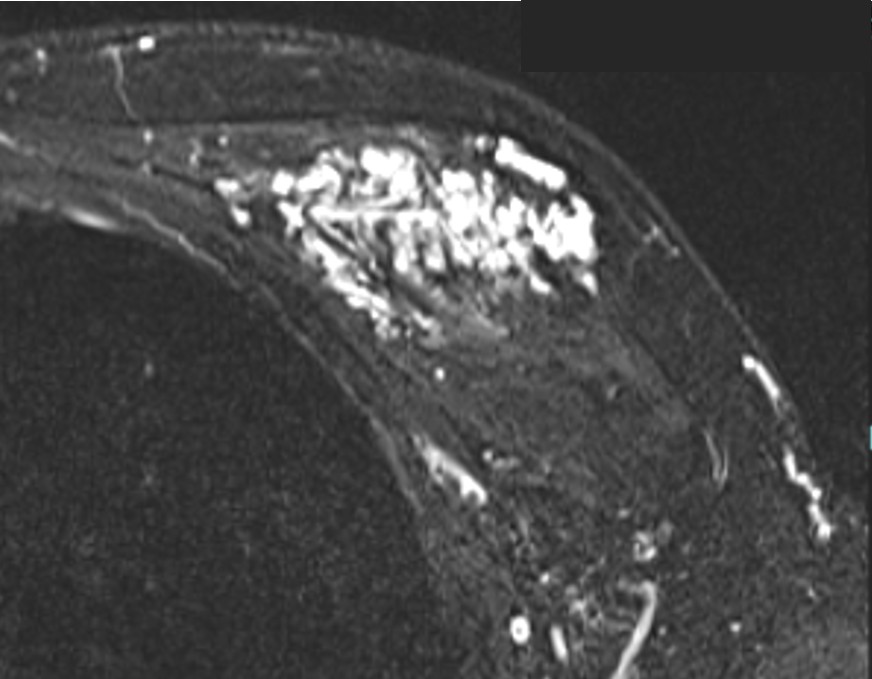 脈管奇形のMRIイメージ