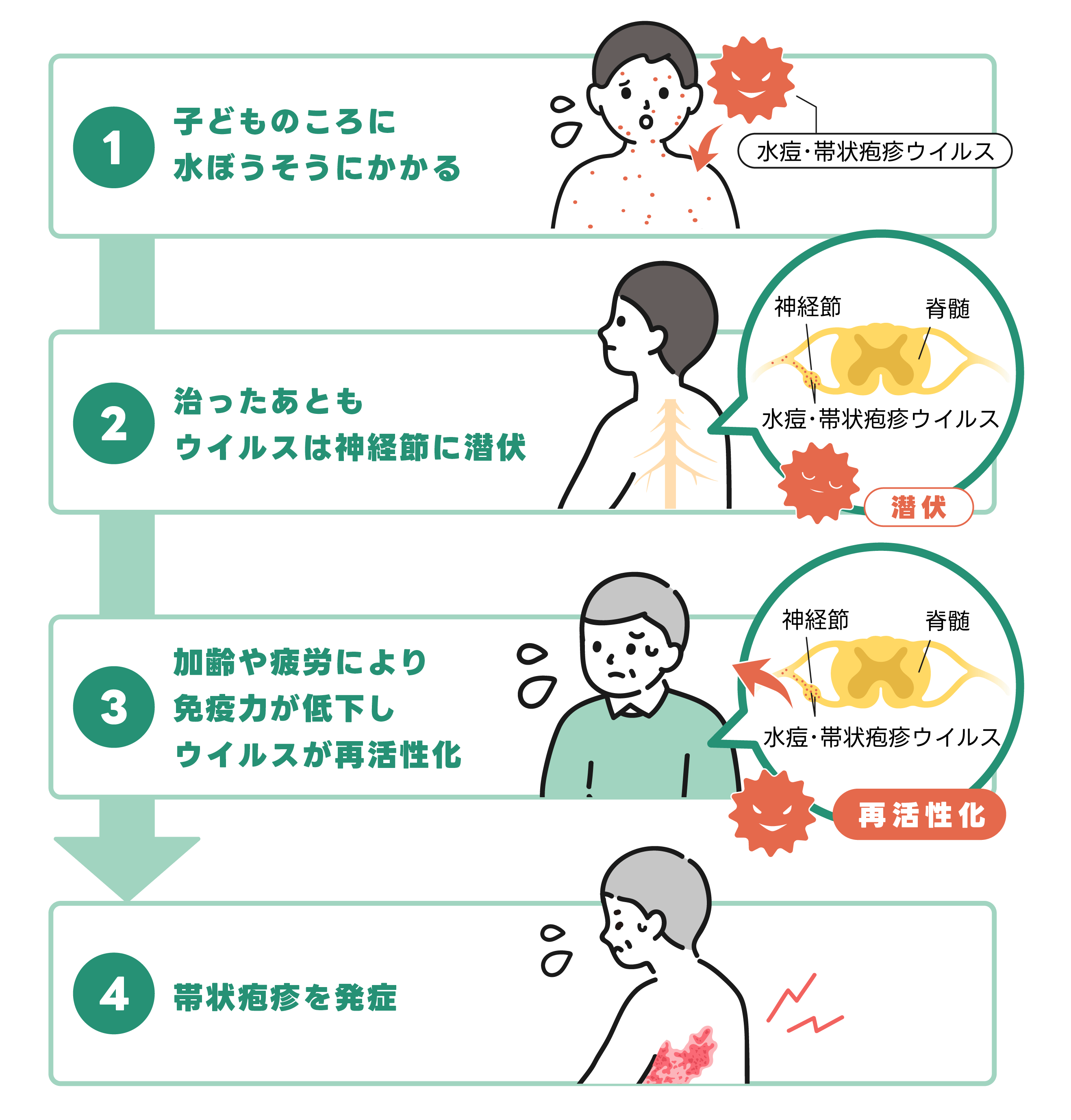 帯状疱疹になる仕組み
①子どものころに水ぼうそうにかかる
②治ったあともウイルスは神経節に潜伏
③加齢や疲労により免疫力が低下し、ウイルスが再活性化
④帯状疱疹を発症