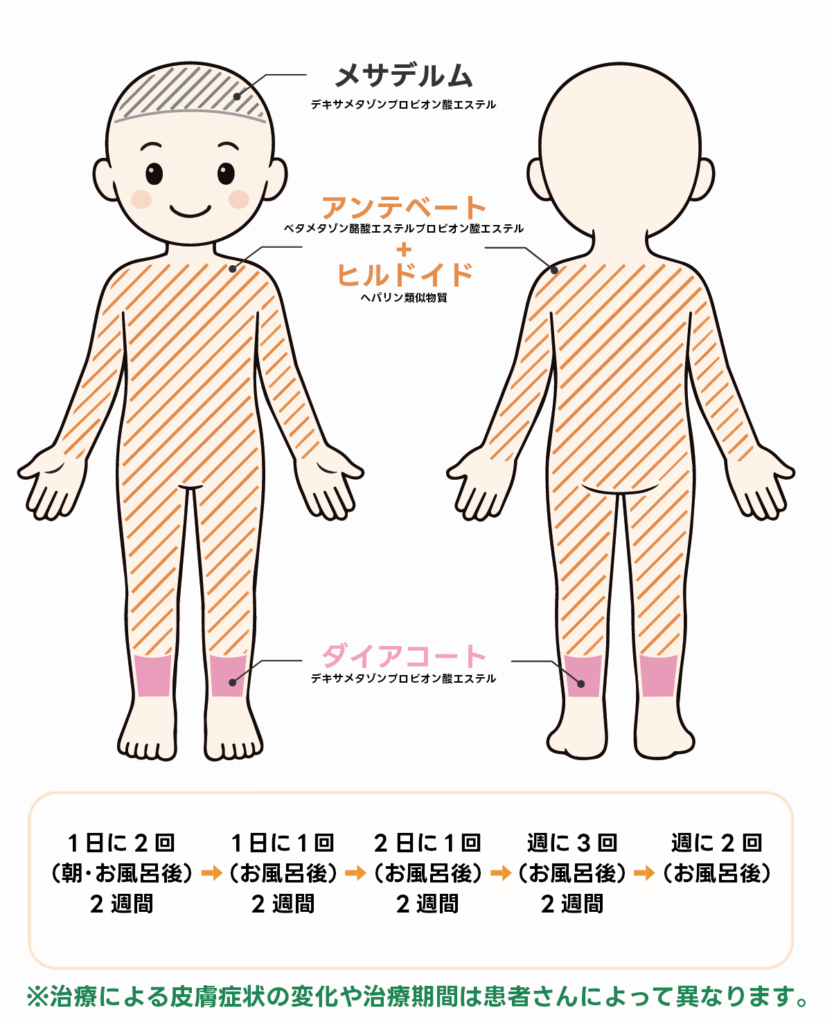 アトピー性皮膚炎の外用指導例。頭部にメサデルム、体幹・腕・脚にアンテベートとヒルドイド、両足首付近にダイアコートを塗り、症状に合わせて塗る回数を段階的に減らしていく方法を示した図。